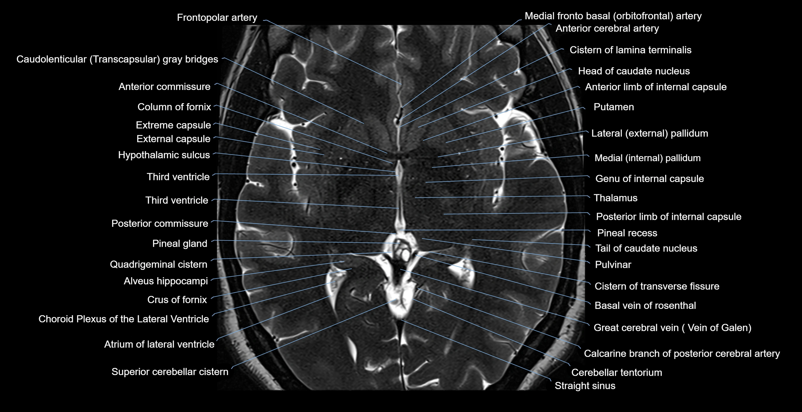 brain axial anatomy 3T MRI images -img-17001-00030.webp